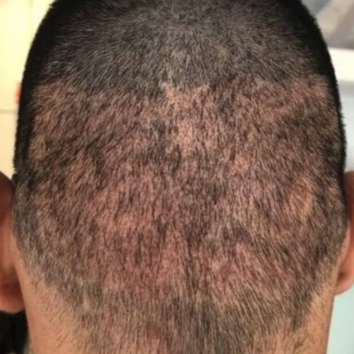 Overharvested donor