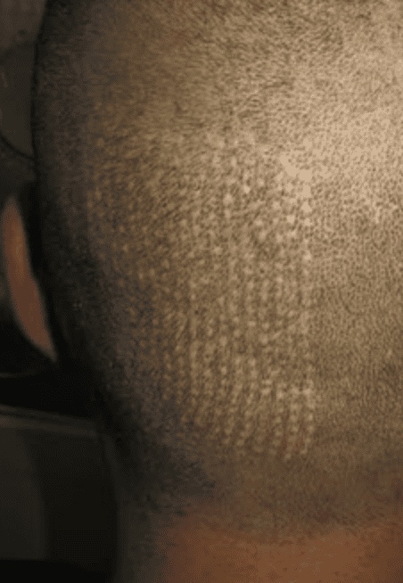 Visible scarring
