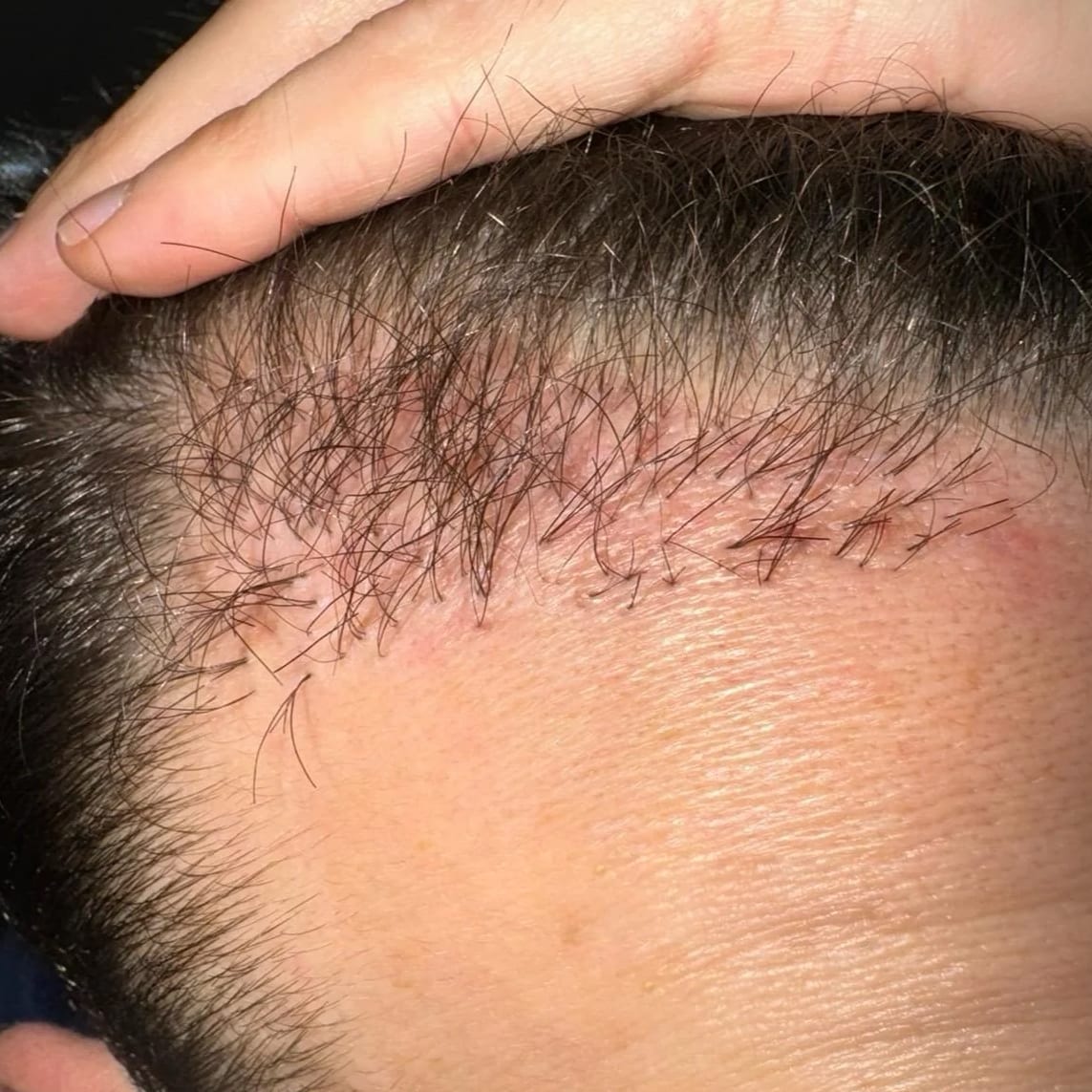 Grafts didn't grow