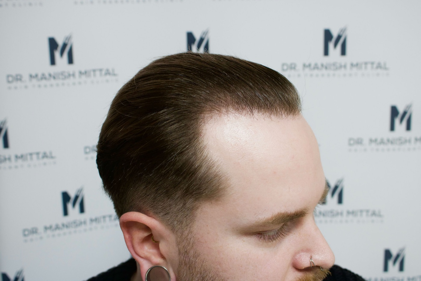 Natural, soft hairline after a hair transplant